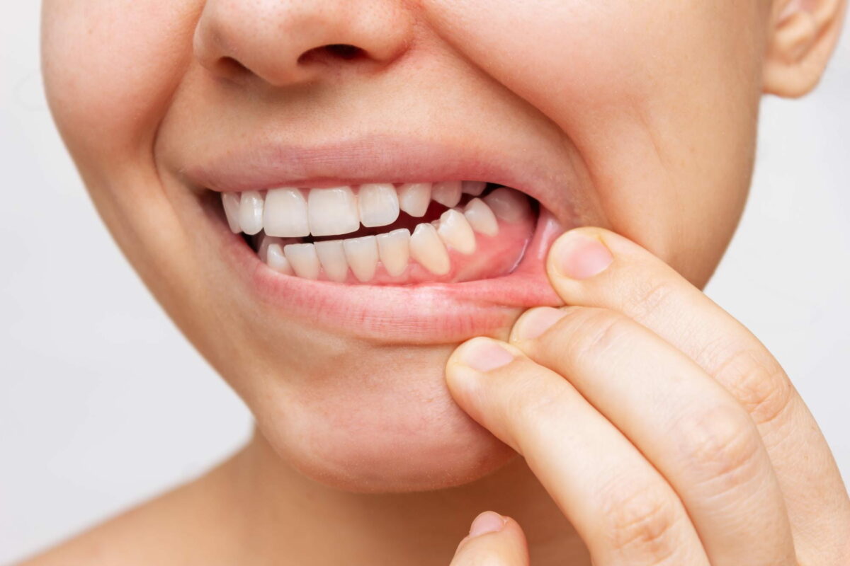 Diş Eti Kaşıntısı: Nedenleri, Çözümleri ve Önleme