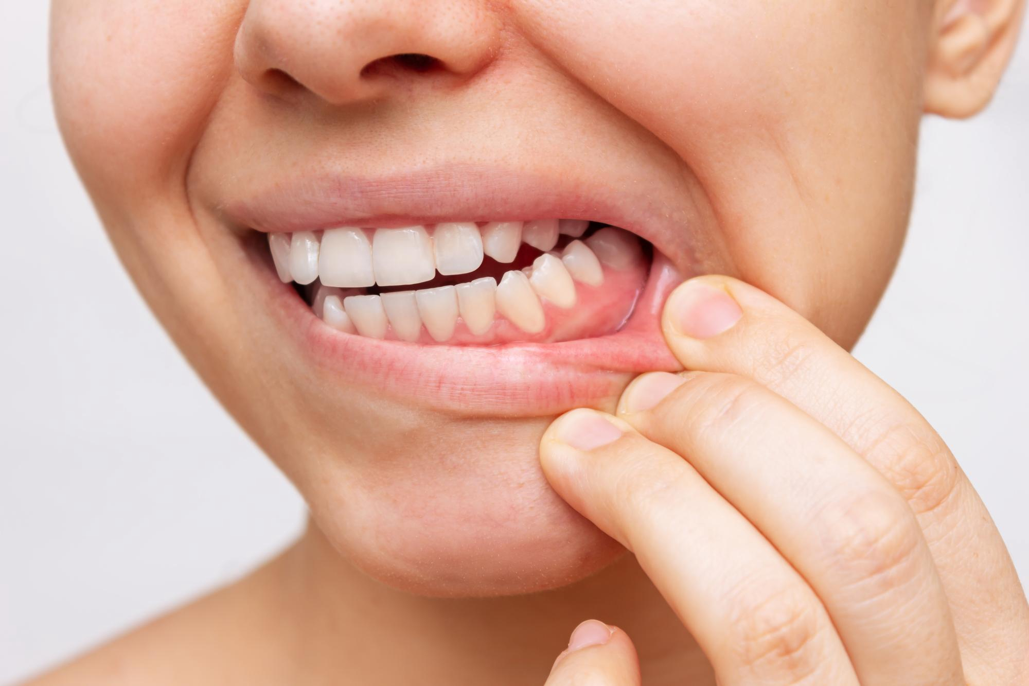 Diş Eti Şişmesi: Nedenleri ve Geçirme Rehberi