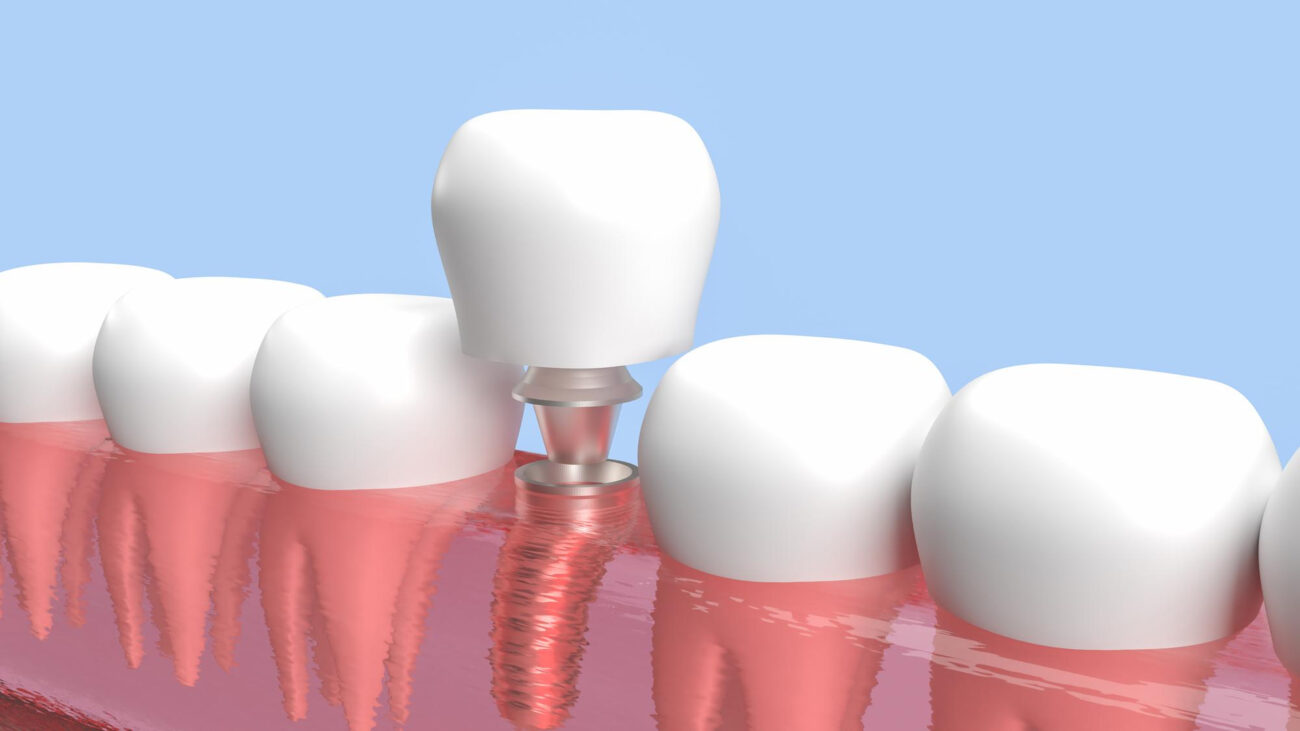 Diş İmplantı Yaptırmadan Önce Bilmeniz Gerekenler