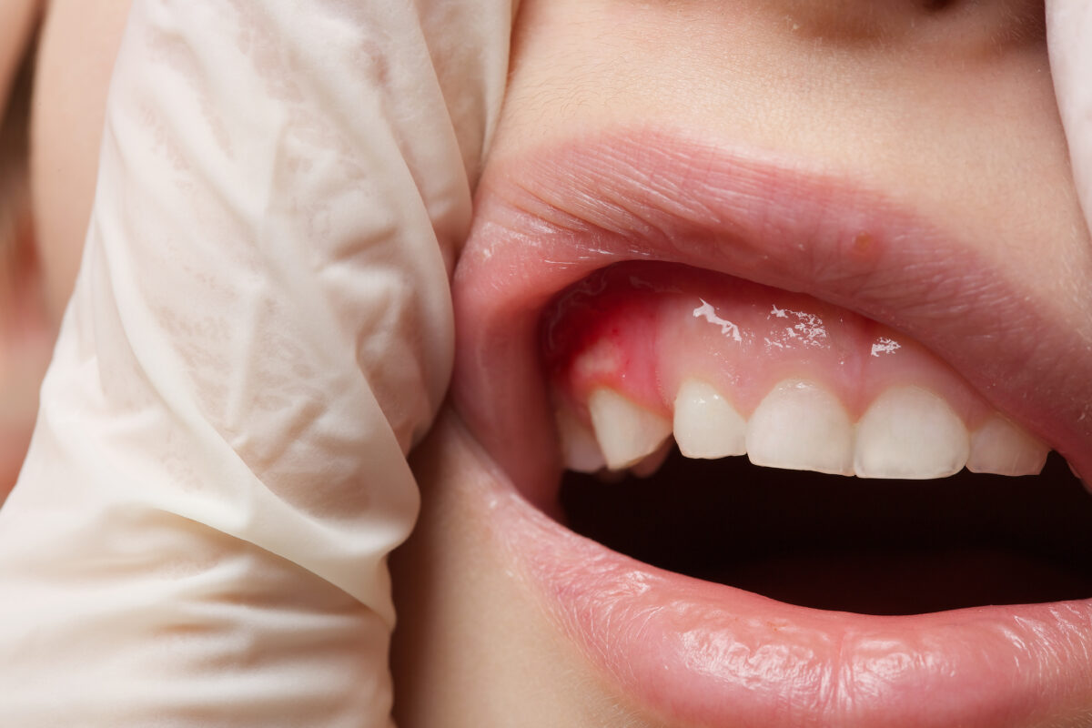 Diş Kisti: Nedenleri, Belirtileri ve Tedavisi