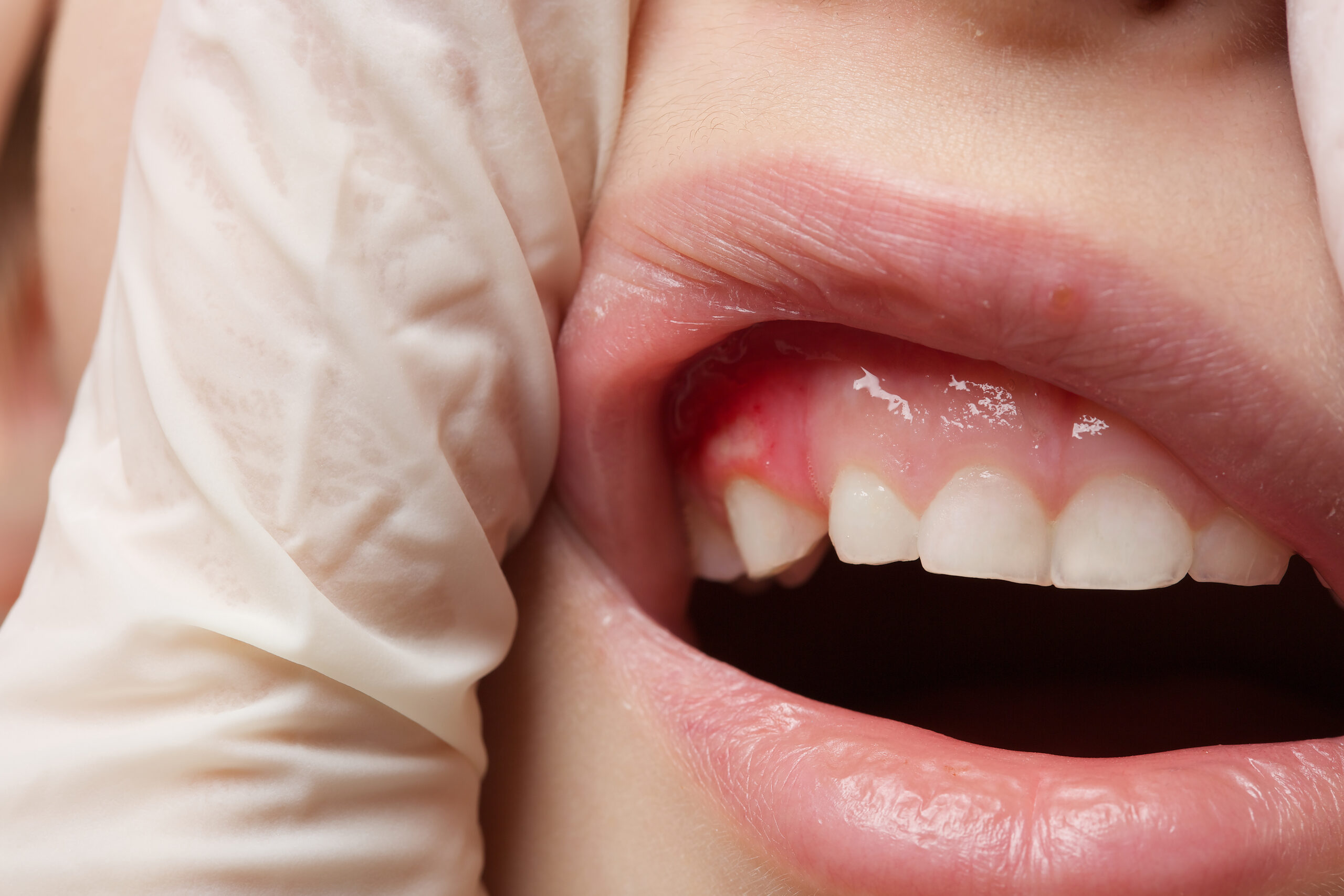 Diş Kisti: Nedenleri, Belirtileri ve Tedavisi