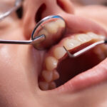 Diş Küretajı Nedir? Nasıl Yapılır ve Sonrası