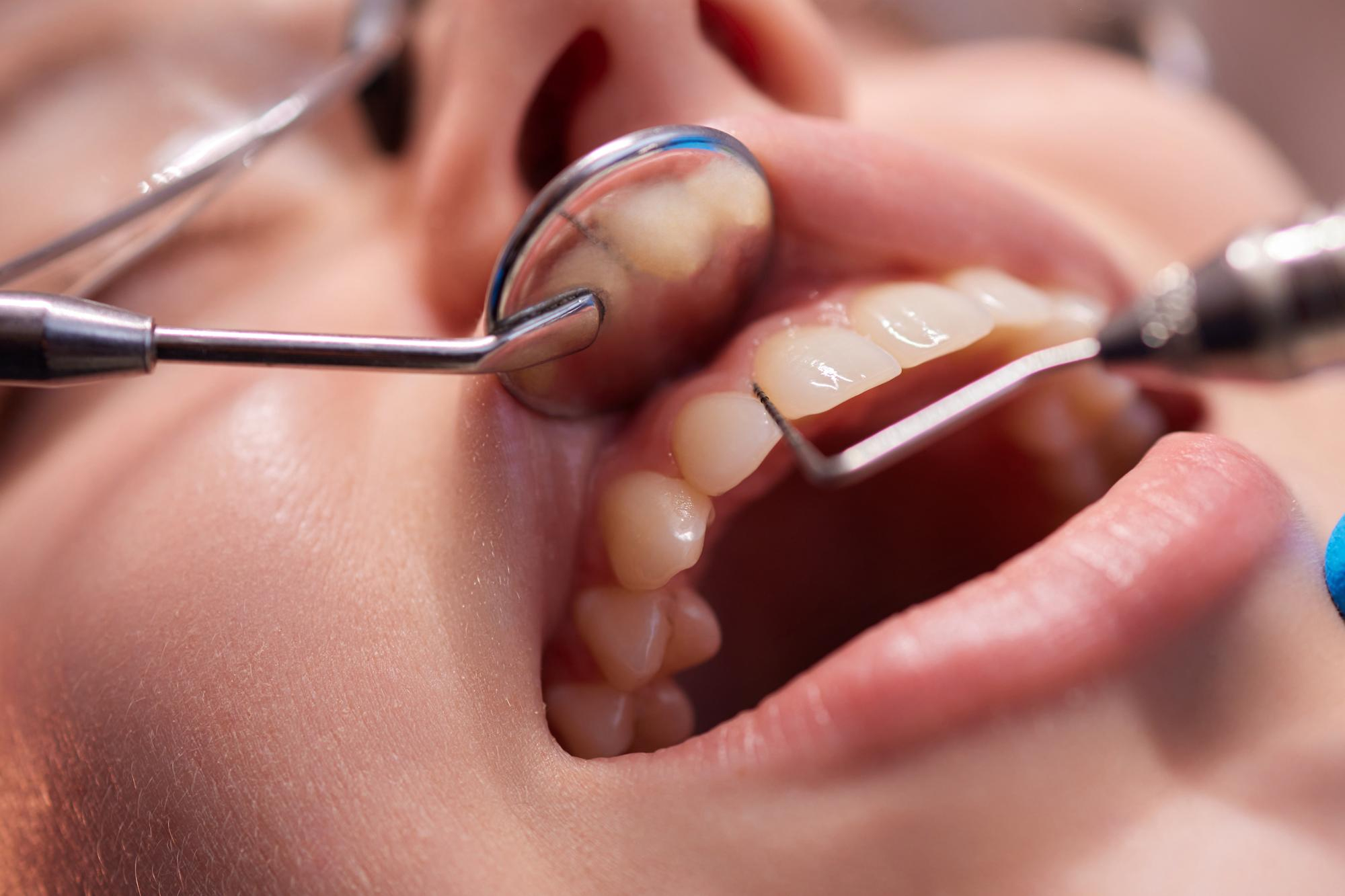 Diş Küretajı Nedir? Nasıl Yapılır ve Sonrası