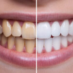 Diş Sararması: Nedenleri ve Geçirme Yolları