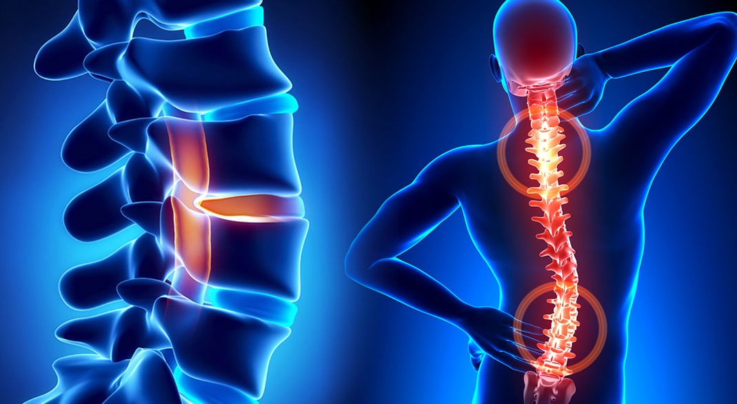 Faset Sendromu: Boyun ve Bel Kireçlenmesi Rehberi