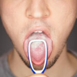 Glossit (Dil İltihabı) Nedir? Belirtiler ve Tedavi