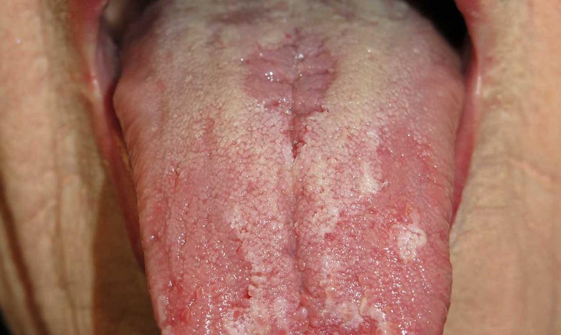 Glossit (Dil İltihabı) Nedir? Belirtiler ve Tedavi