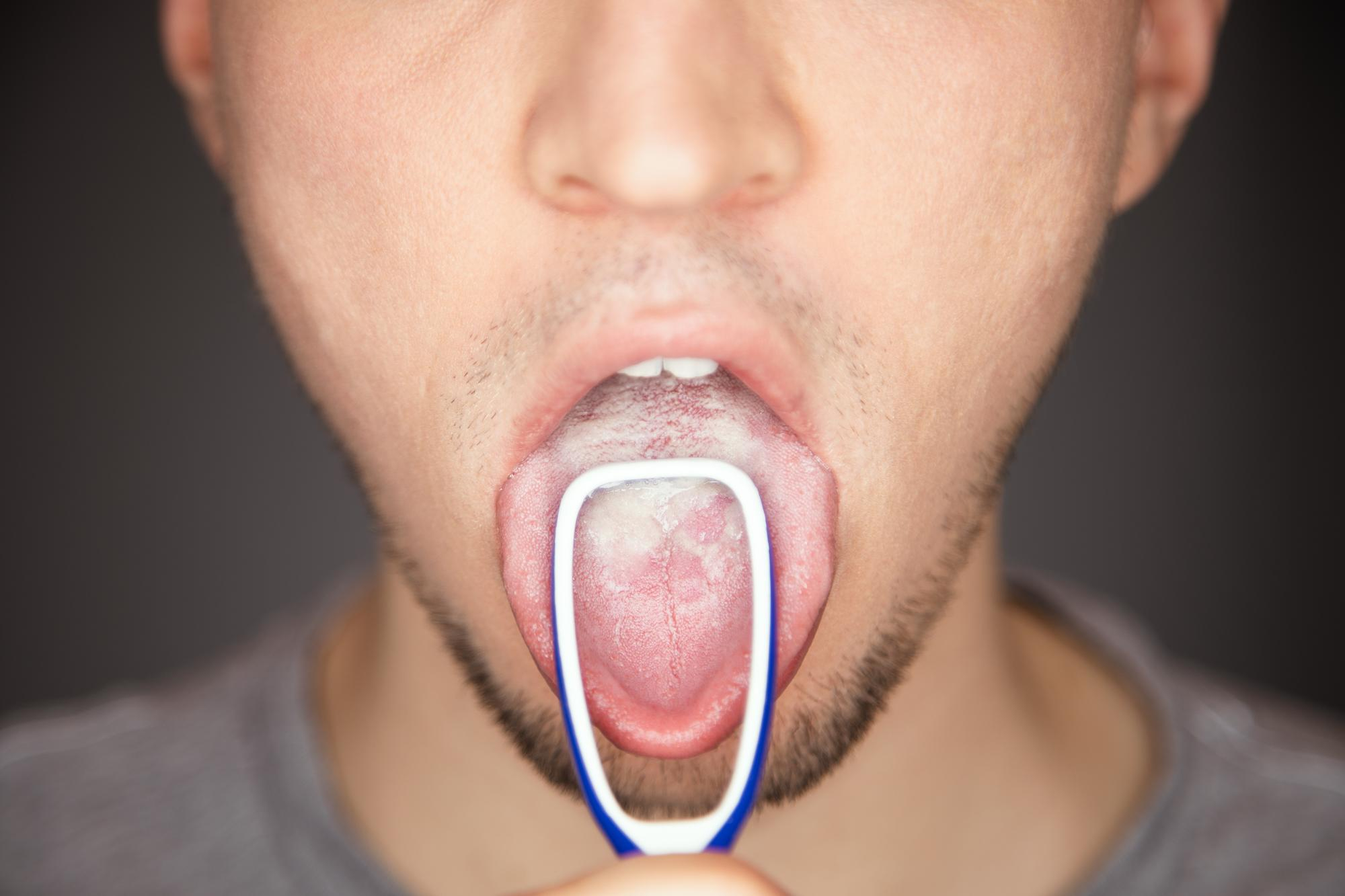 Glossit (Dil İltihabı) Nedir? Belirtiler ve Tedavi