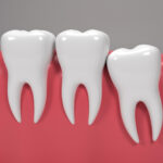 Gömülü Diş Tedavisi: Neden Olur, Nasıl Yapılır?