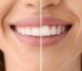 Gummy Smile Tedavisi: Nedenleri ve Çözüm Yolları