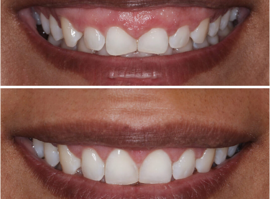 Gummy Smile Tedavisi: Nedenleri ve Çözüm Yolları