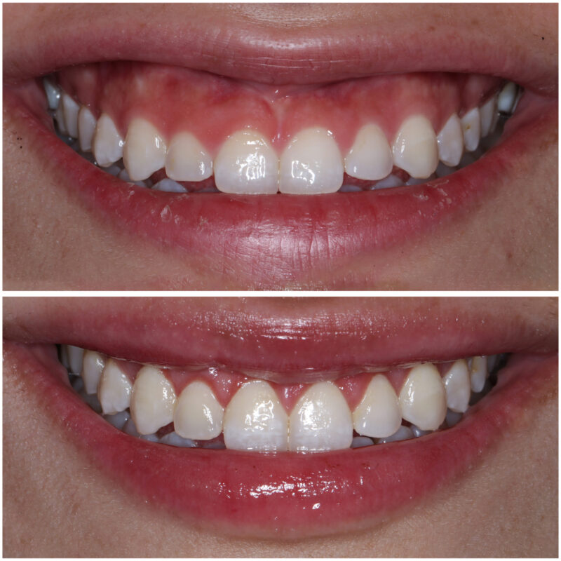 Gummy Smile Tedavisi: Nedenleri ve Çözüm Yolları