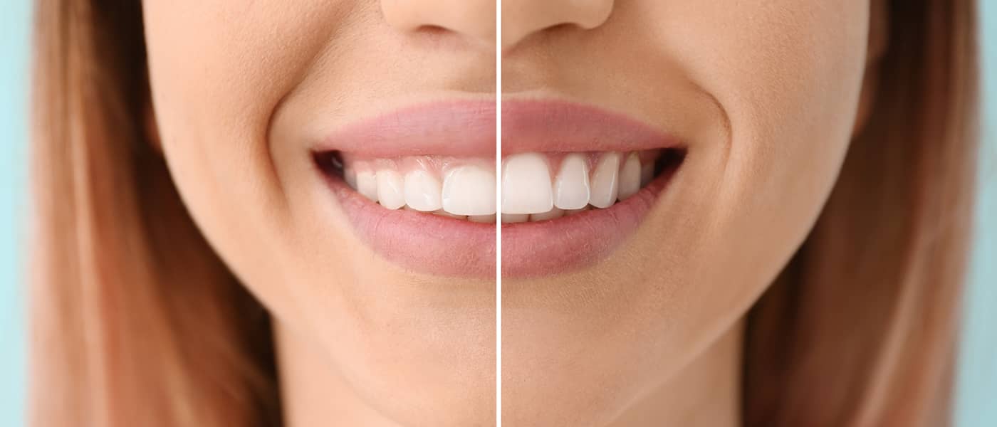 Gummy Smile Tedavisi: Nedenleri ve Çözüm Yolları