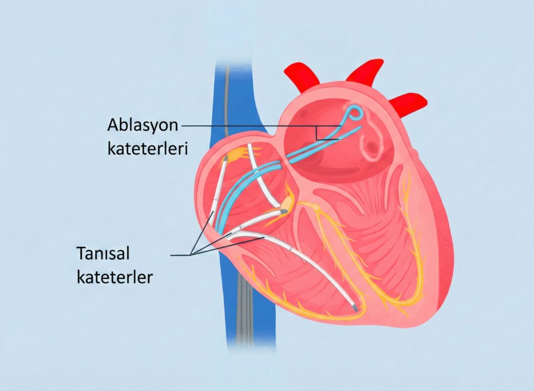 Kalp Ablasyonu Nedir? Ablasyon Tedavisi Nasıl Yapılır?