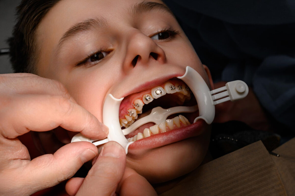 Maloklüzyon Tedavisi: Nedenler ve Doğru Yaklaşım