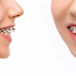 Overbite Tedavisi: Nedir, Belirtiler ve Çözümler