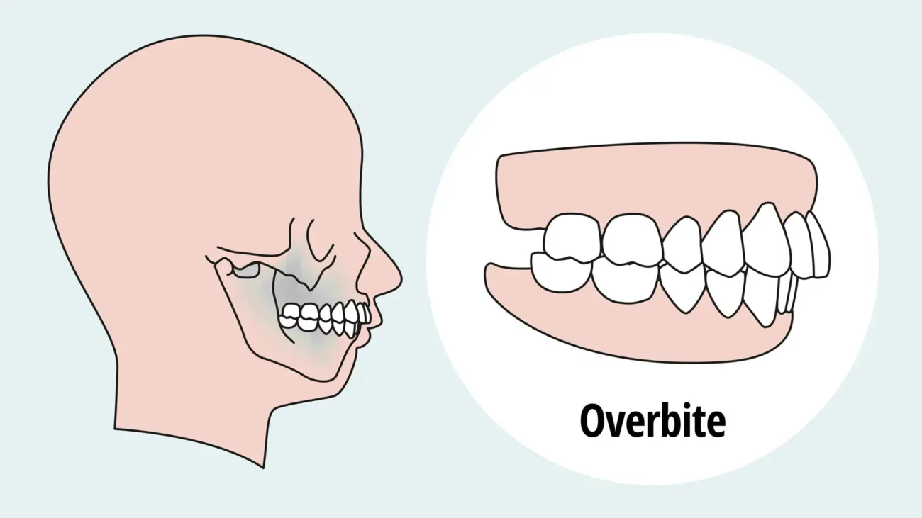 Overbite Tedavisi: Nedir, Belirtiler ve Çözümler