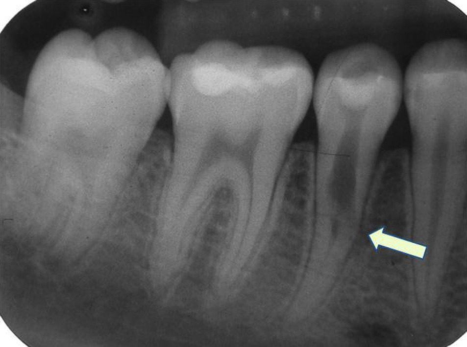 Diş kökünün üst ve orta kısmında düzensiz bir koyuluk (radyolusens) ve bunun bitişiğindeki kemik dokusunda hilal şeklinde bir lezyon görülmektedir.
