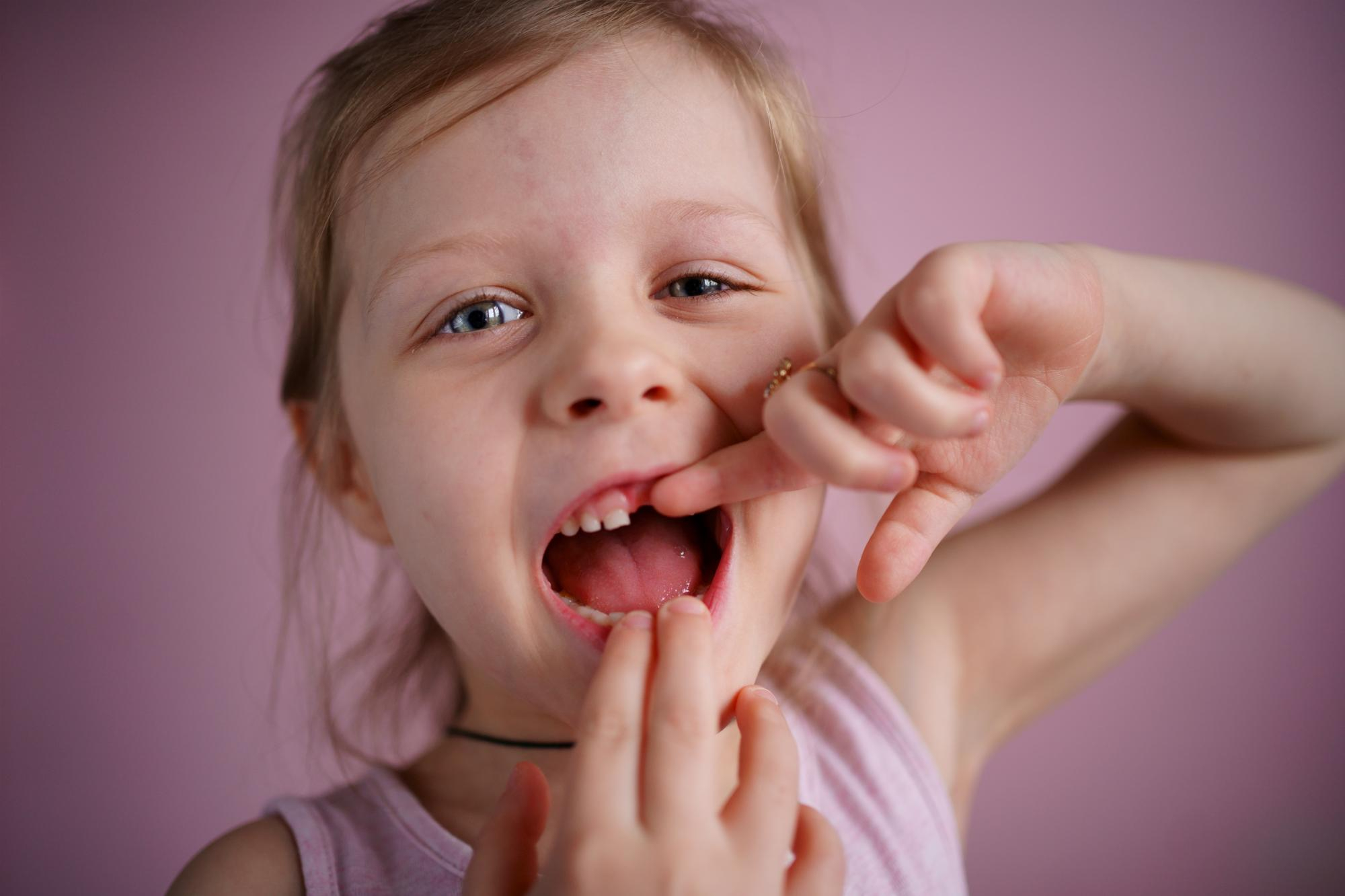 Süt Dişi Çürükleri: Çocukları Korumanın 5 Yolu