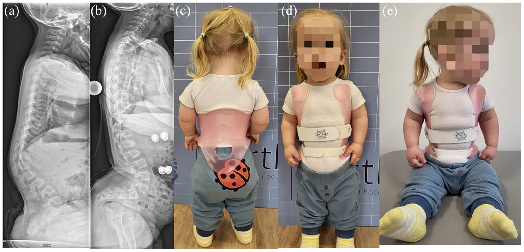Şekil 1. Akondroplazi olan üç yaşındaki kız çocuğu: (a) kaslı gövde stabilitesinde iyileşme olmasına rağmen devam eden lomber kifoz, (b) korse ile çekilmiş radyografi (not: korse ile ve korsesiz şiddetli lumbosakral lordoz) ve (c)–(e) korse ile klinik tablo.