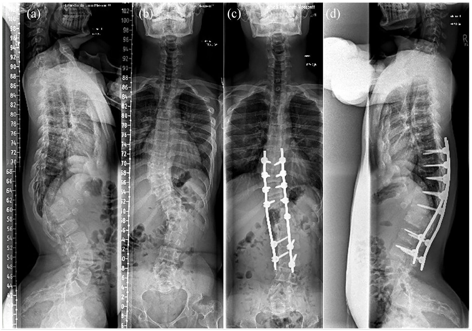 Akondroplazi Nedir: Belirtiler ve Tedavi Yaklaşımı