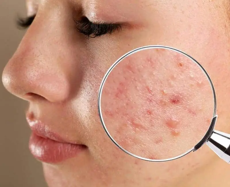 Aktif Akne Tedavisi
Sivilce, dünya çapında milyonlarca insanı etkileyen en yaygın cilt hastalıklarından biridir. Aktif olduğunda rahatsız edici ve kişinin özgüvenini etkiler; siyah noktalar, beyaz noktalar, kırmızı iltihaplı sivilceler ve püstüllerle karakterize edilir. 