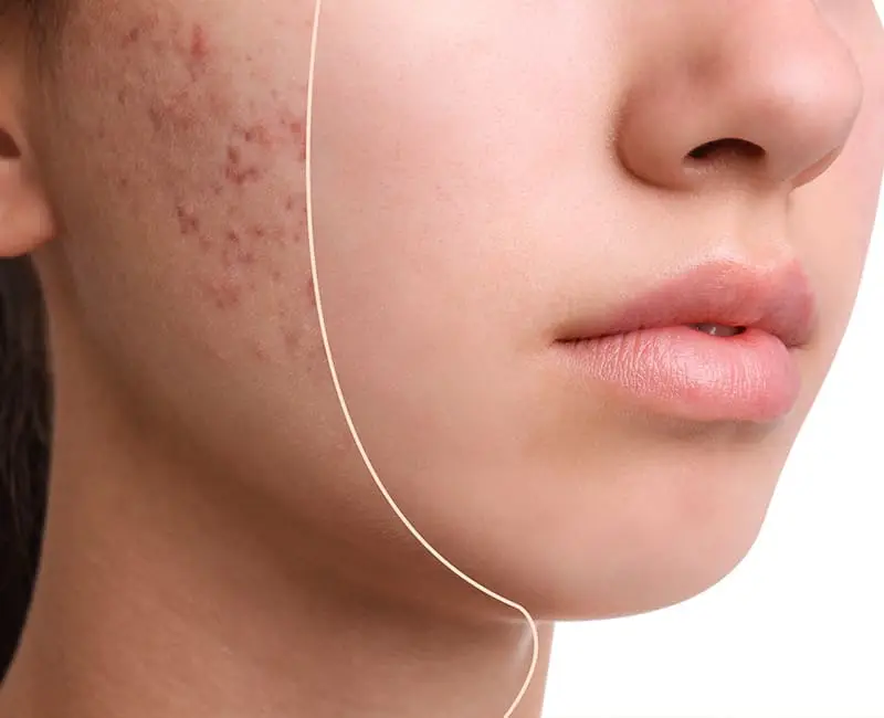 Aktif akne, ciltte sivilce ve diğer lezyonların salgınının yaşandığı dönemi ifade eder. Başlıca saç foliküllerinin yağ, kir ve ölü cilt hücreleriyle tıkanmasından kaynaklanır ve bu da iltihaplanmaya yol açar.