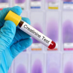 Kreatinin Nedir? Kreatinin Yüksekliği ve Düşüklüğü