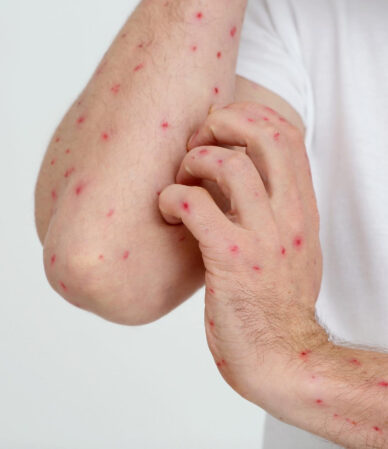 Maymun Çiçeği Virüsü (MPOX) Nedir? Belirtiler