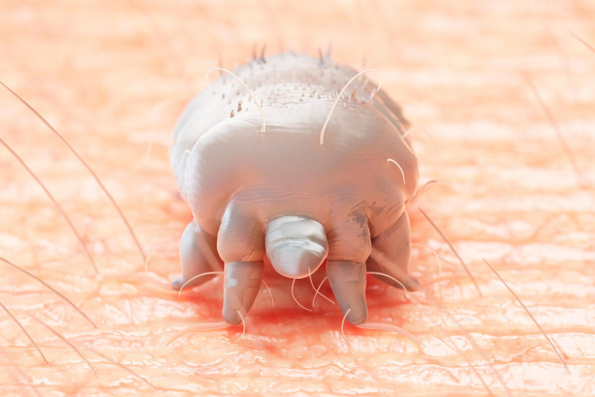 Uyuz Hastalığı: Belirtiler, Tanı ve Tedavi Yöntemleri