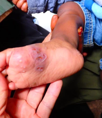 Uyuz Hastalığı: Belirtiler, Tanı ve Tedavi Yöntemleri