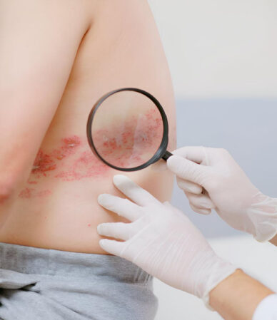 Zona Hastalığı Nedir? Belirtiler, Nedenler, Tedavi