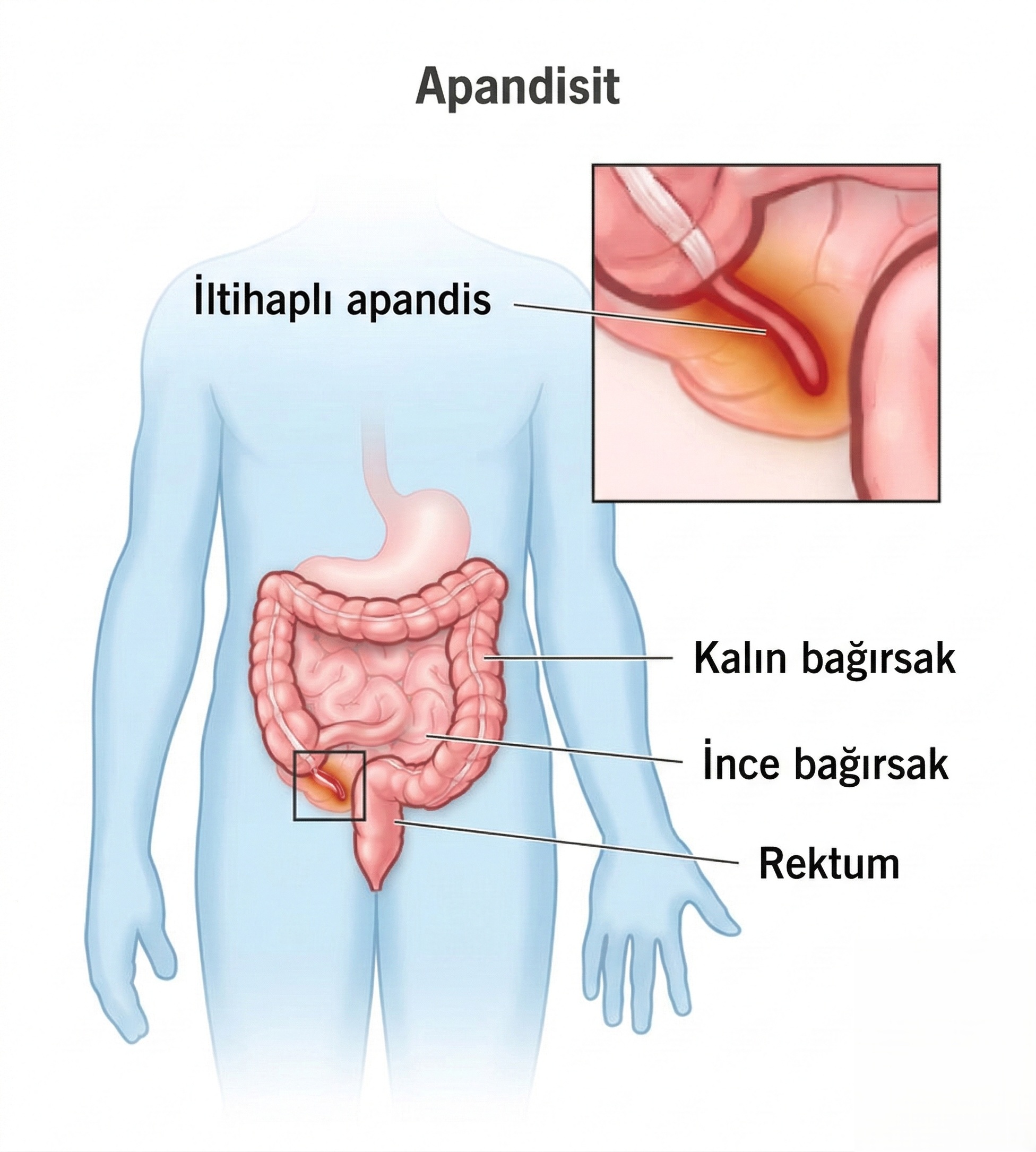 Apandisit: Belirtileri, Nedenleri ve Tedavisi
